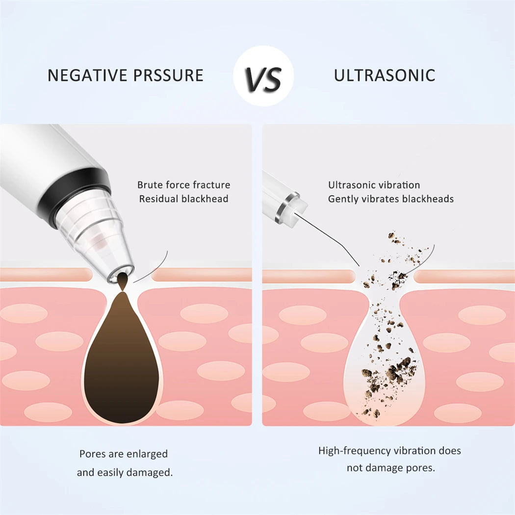 Ultrasonic Skin Scrubber EMS Vibration Ion Acne Pore Blackhead Remover